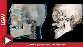 Maxilla Reconstruction Surgery 3D Animation [upl. by Nitsa]