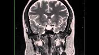 Inferior Right Temporal Encephalocele [upl. by Stoll]