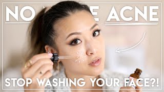 HOW I GOT RID OF MY ACNE Stopped washing my face [upl. by Lise139]