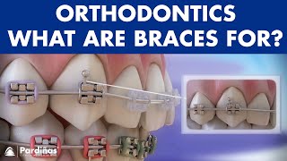 How Braces Work Elements of the orthodontic treatment and its role © [upl. by Tamma]