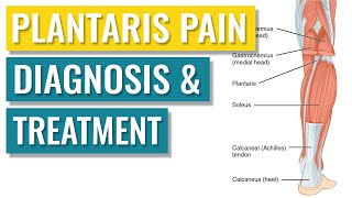 Plantaris Tendonitis  Symptoms and Treatment [upl. by Eusassilem]