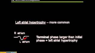 1215 Lead ECG Atrial Hypertrophy [upl. by Odracer752]