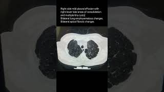 Right side mild pleural effusion with right lower lobe areas of consolidationpulmonologist [upl. by Eniledgam579]