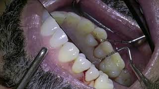 IMMEDIATE IMPLANT PLACEMENT IN CLASS 2B SOCKET [upl. by Vieva]