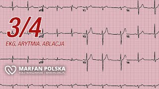 Co to jest ablacja Jak poradzić sobie z arytmią Czym jest EKG [upl. by Attiuqahs956]