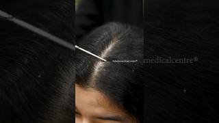 Keravive exfo Treatment  Dandruff Treatment in Delhi  Best Hair Clinic  Dr Nandini Dadu [upl. by Landy685]