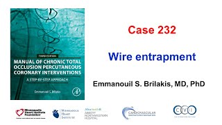 Case 232 Wire entrapment [upl. by Collum749]