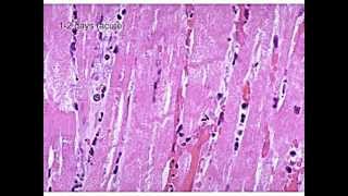 Evolution of a Myocardial Infarction [upl. by Springer774]