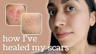 Healing Hyperpigmentation  Deep Pitted Acne Scars this is what I’ve done [upl. by Cathee]