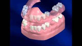 Dentadura Parcial Removible [upl. by Laris]