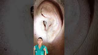 Ear Wax Removal 8 [upl. by Zilevi]