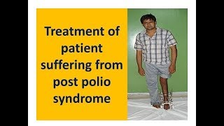 Treatment of patient suffering from post polio syndrome [upl. by Lepper]