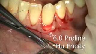 Periodontal Microsurgery AlloDerm Grafting Lower Anterior [upl. by Eitsud510]