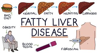 Understanding NonAlcoholic Fatty Liver Disease [upl. by Sitruk]