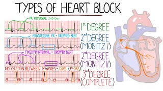 Heart Blocks Made Easy  1st 2nd Mobitz 1Wenckebach amp Mobitz 2 3rd Complete  with ECGs [upl. by Birch]