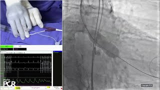 Align for the future with nextgeneration balloon expandable transcatheter heart valve technology [upl. by Dorison603]