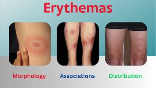 Erythemas Uncovered Insights into Morphology Associations and Distribution [upl. by Nolyaw]