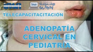 Adenopatía Cervical en Pediatría  Telecapacitación INSN [upl. by Ahtrim]