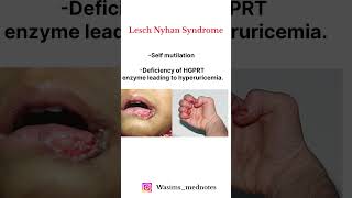 Lesch Nyhan Syndrome High yield Topic  🔥🔥💯💯 fmge shorts [upl. by Utas]