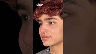 Before and After Non Surgical Nose Job nonsurgicalrhinoplasty [upl. by Azalea]