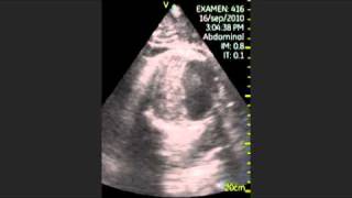 VSCAN Abdominal aortic aneurysm Pocket Ultrasound Aneurisma aórtico abdominal Eco de bolsillo [upl. by Fisken]