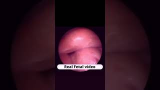 Real fetal video DrPoonam Maggo fetal baby love short shortsvideo [upl. by Nhguav]