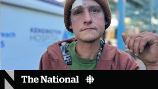 How a fleshrotting ‘zombie drug’ is complicating the overdose crisis [upl. by Marcellina]