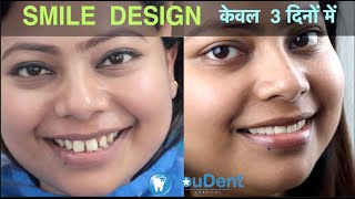 Teeth Gap Treatment in 5 Days I Zirconia Cap I Best Smile Design Dentist in INDIA youdent ​ [upl. by Leirbma]