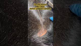 How to reduce Lice eggs in hairLice removalrid lice treatmentlice treatment parlourlice treatmen [upl. by Plunkett95]