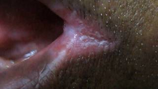 How To Cure Angular Cheilitis In 3 days [upl. by Dunson]