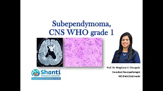 Subependymoma CNS WHO grade 1 [upl. by Bathilda]