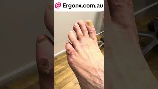 Warning blood  5th toe hard corn removal by podoatrist in podiatry clinic ergonxcomau [upl. by Giddings550]