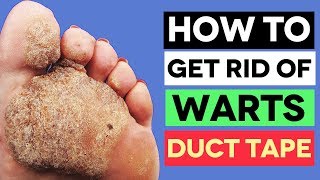 How To Safely Get Rid Of Warts With DUCT TAPE What Everyone Ought to Know [upl. by Aihtnys406]