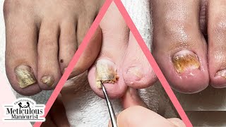 How to Fix Toenails that Change Shape and Color [upl. by Itnaihc448]