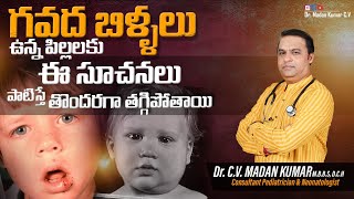 Mumps in Telugu గవద బిళ్ళలుMumps in children Dr Madan Kumar cv [upl. by Anirec]