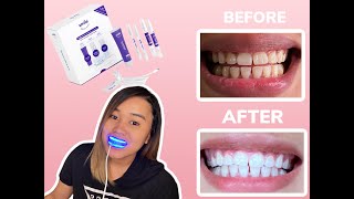 SMILE DIRECT CLUB whitening system  DIY teeth whitening  HONEST REVIEW  DOES IT WORK [upl. by Tiler]