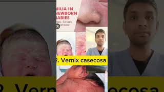 milia and vernix casecosa and lanugo shorts nursingeducation [upl. by Eiggep]