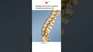 Vertebroplasty procedure short [upl. by Ecital]