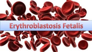 Erythroblastosis fetalisHaemolytic disease of New bornHDN [upl. by Nerty]