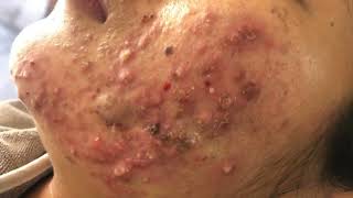 Whiteheads on foreheads  Giant Acne amp Pimple Treatment  Blackhead Removal  Remove Blackheads [upl. by Asek]