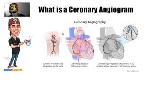 What is a Coronary Angiogram Explained Simply [upl. by Shantee]