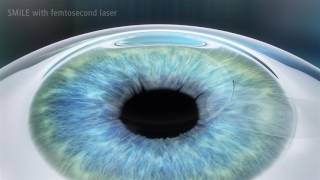 3rd Generation SMILE Laser Eye Surgery  Revolutionary bladeless procedure [upl. by Nodnas799]