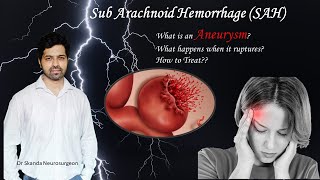 SAH  Sub Arachnoid Hemorrhage Brain Aneurysm rupture Explanation by Dr Skanda Neurosurgeon [upl. by Keene]