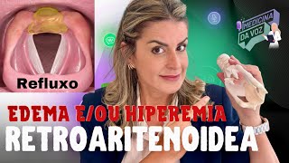 Edema retroaritenoide Refluxo Faringo Laringeo [upl. by Atilem]