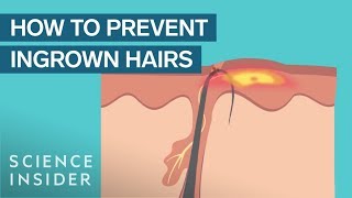 What Are Ingrown Hairs — And How To Treat Them [upl. by Eiramlirpa]