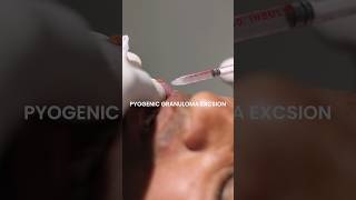 Sizzling a Pyogenic Granuloma at Skinaa Clinic viral shorts [upl. by Holli773]