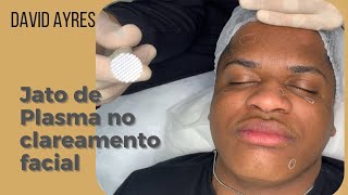 Jato de Plasma para clareamento facial com técnica de remoção de pintas [upl. by Dleifrag]