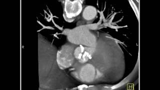 4D Imaging of the Aortic Valve Aortic valve 3 of 3 [upl. by Regazzi93]