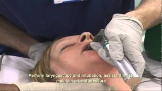 Intubation Extubation 37 [upl. by Pilloff]