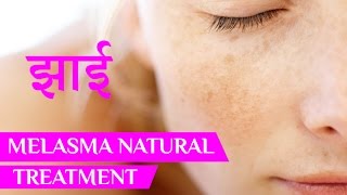 झाइयां  Melasma Treatment  pigmentation  face pigmentation  pigmentation on face  Beauty Tips [upl. by Ettari414]